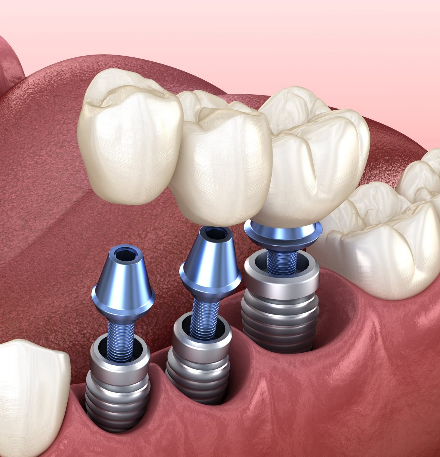 Какие бывают зубные импланты, и как их ставят?