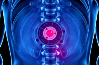 Грыжа межпозвоночного диска — когда операция становится лучшим решением и чего от неё ждать